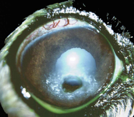 <p>what is this cause of corneal ulcer</p>