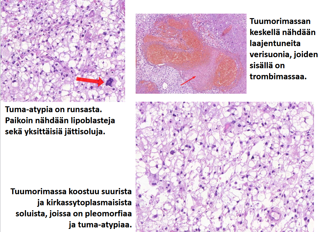 <p>päättele kuvan avulla, mikä tauti on kyseessä?</p>