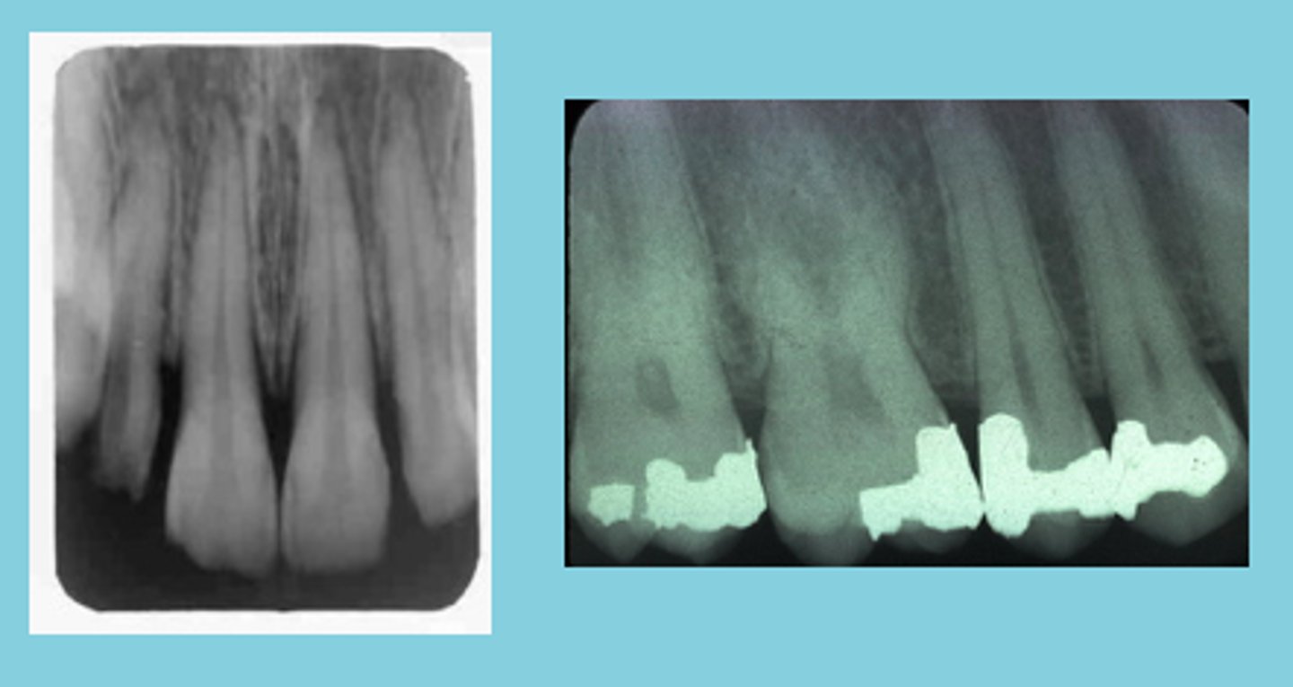 <p>results from insufficient vertical angulation</p>