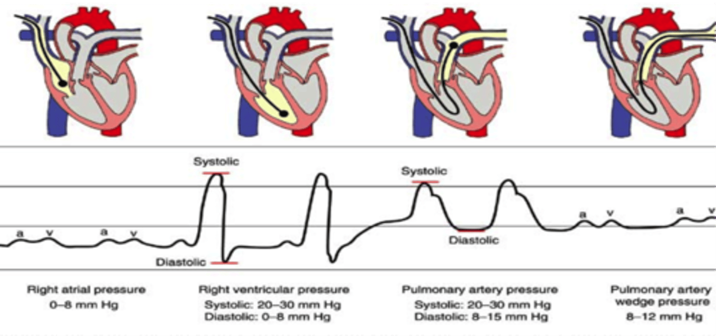<p>- PAP waveform should be present if PAwP is displayed contact nursing.</p><p>- Watch shoulder ROM</p>