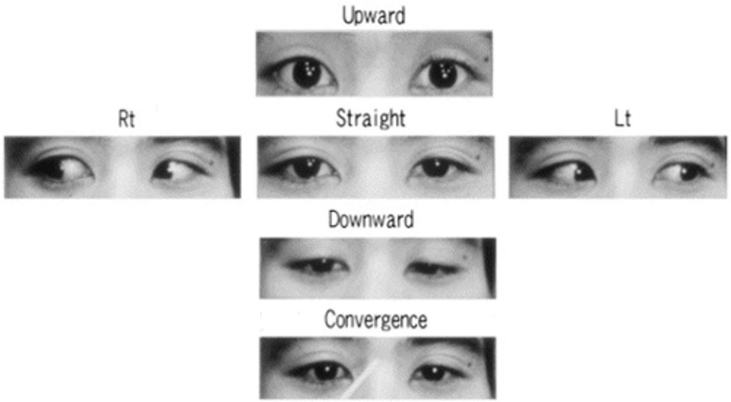 <p>- L and R intact</p><p>- look up -- cant -- raise eyelids but eyes don't move</p><p>- look straight -- relax eyes</p><p>- downward -- look at you but relax eyelids</p><p>- can't cross their eyes</p>