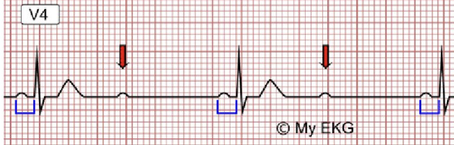 <p>onda P que no conduce QRS, no hay alargamieto de PR</p><p>se origina en el HIS-PURKINJE</p>