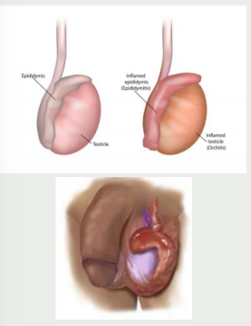 <p><strong>Epididymitis</strong></p><p>-Severe ______ of sudden onset in scrotum, relieved by ________ (+ Prehn sign), also rapid swelling and fever </p><p>-Inspection → __________ and erythematous scrotum</p><p>-Palpation → exquisitely _____, enlarged epididymis </p>