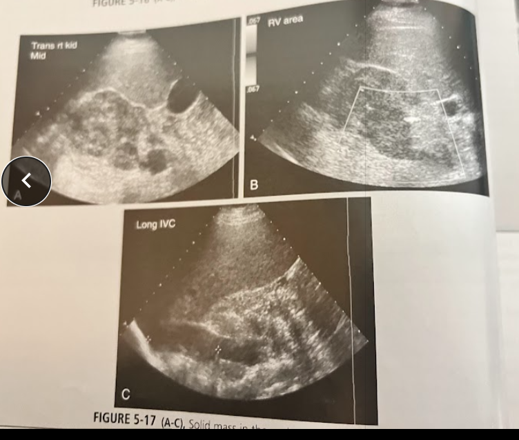<p>A 40 year old man w/clinical hx of gross hematuria is seen for a UT sonogram. No priors. A mass is seen in these images. Where is the mass located and discuss the diagnosis.</p>