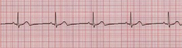 <p>What does this EKG show?</p>