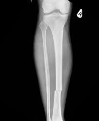 <p>horizontal fracture - in ulna </p>