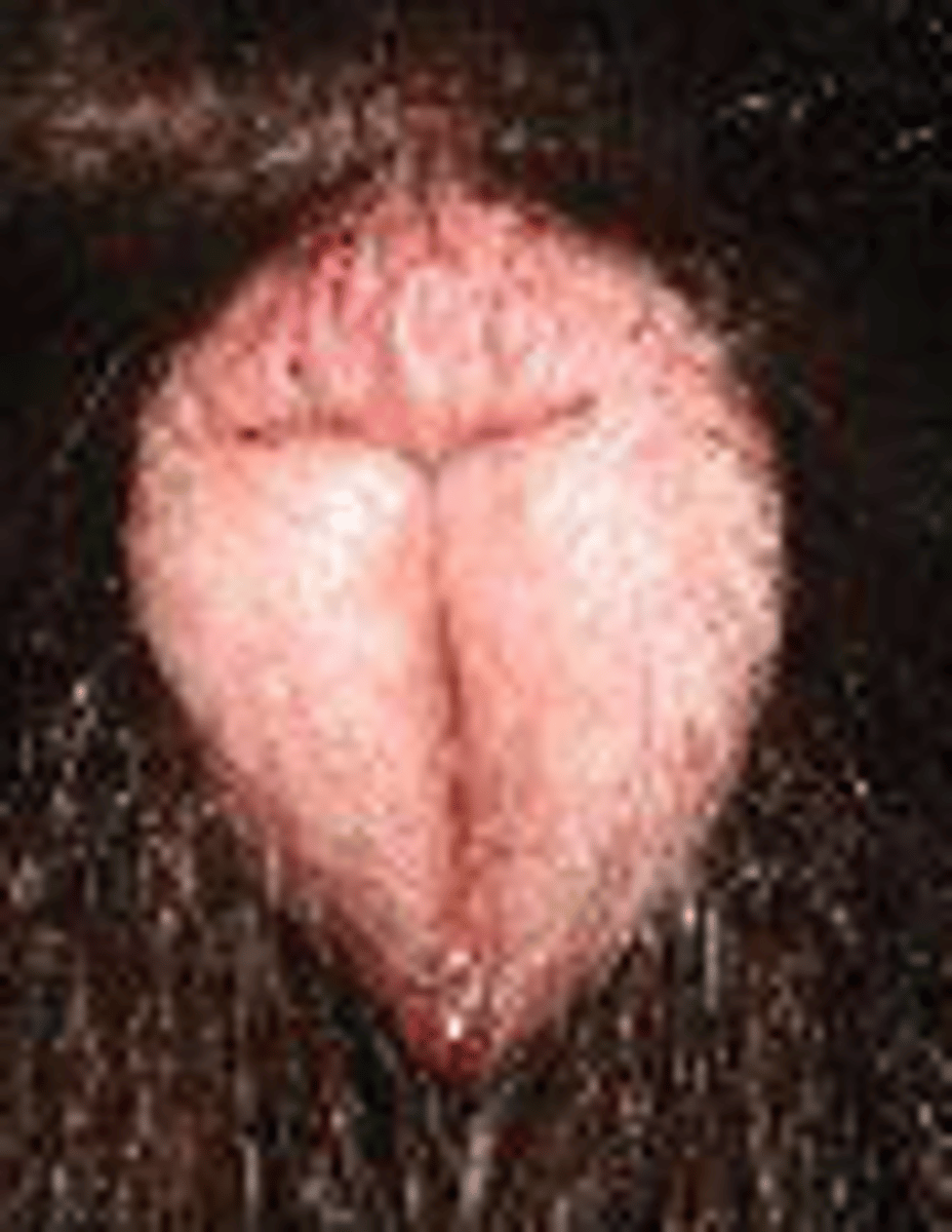 <p>Der skal være ødem</p>