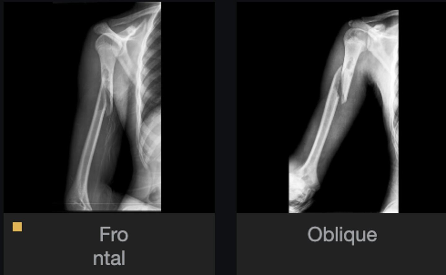 <p>Most likely diagnosis?</p>