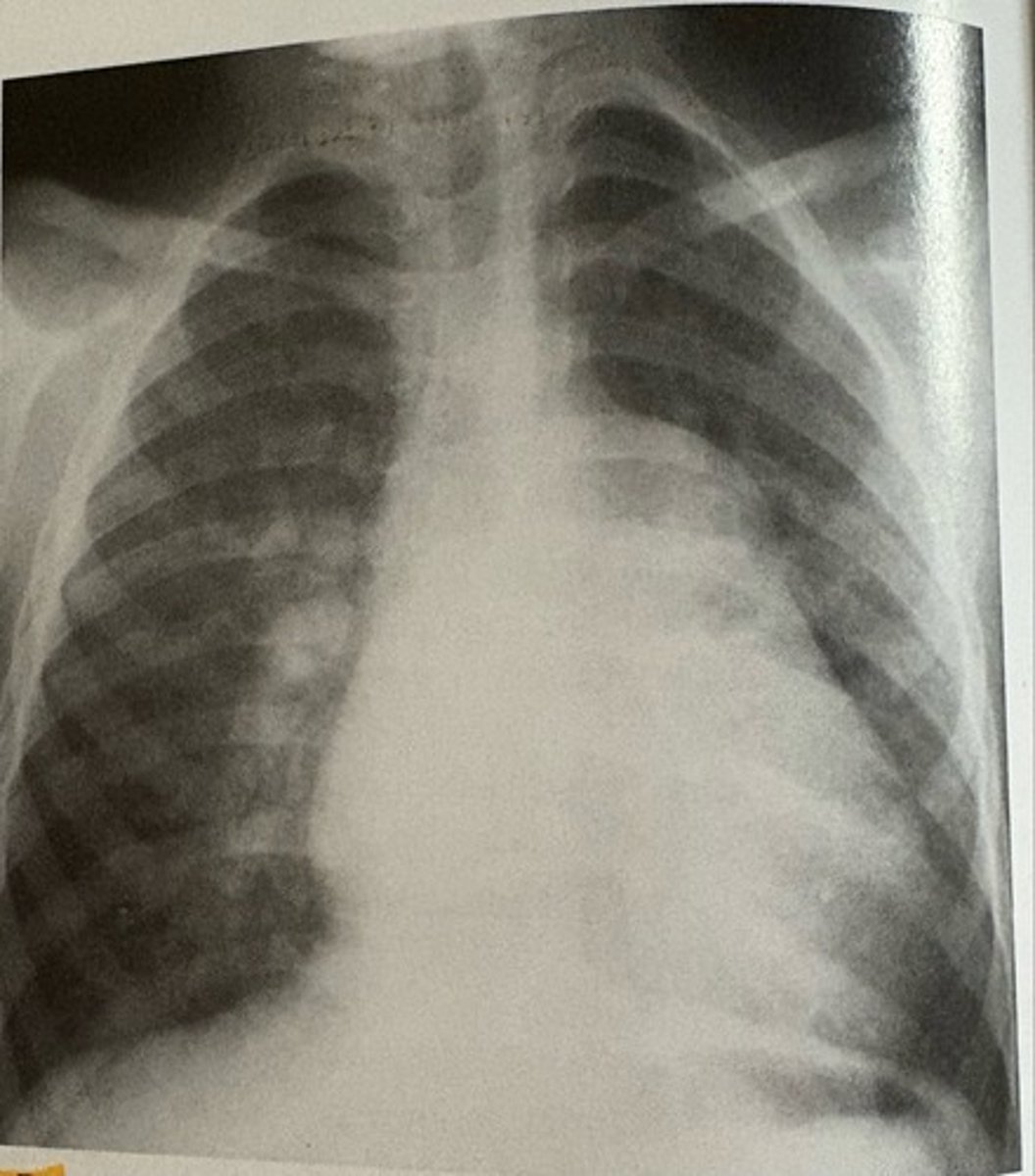 <p>what pathology is present?</p>