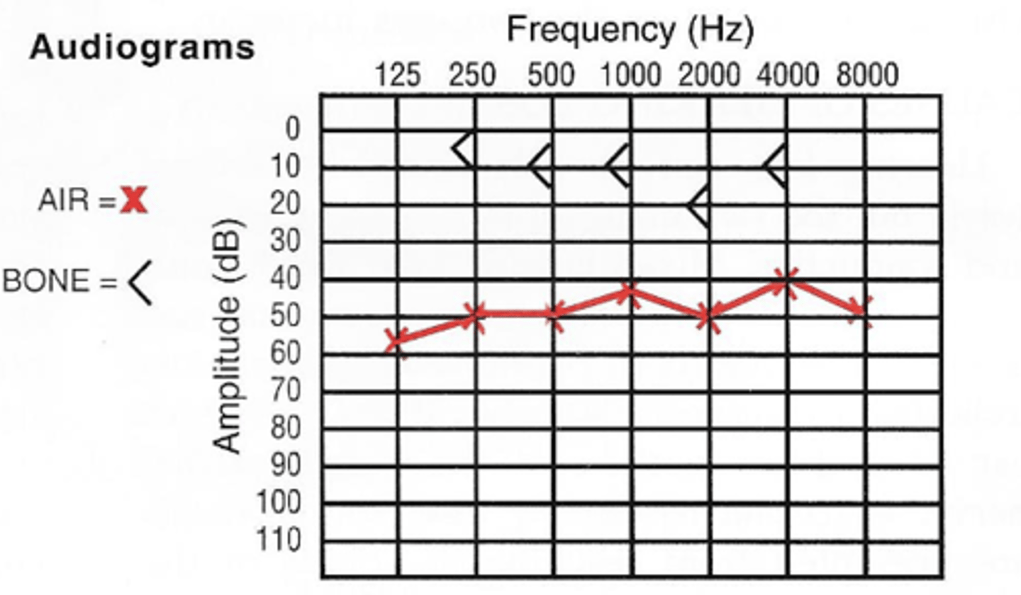 <p>-4& of population</p><p>-Occurs in families</p><p>-Manifest after puberty, pregnancy or menopause</p><p>-Symptoms: Conductive hearing loss bone impeding stapes movement</p><p>-May result in sensorineural hearing loss</p>