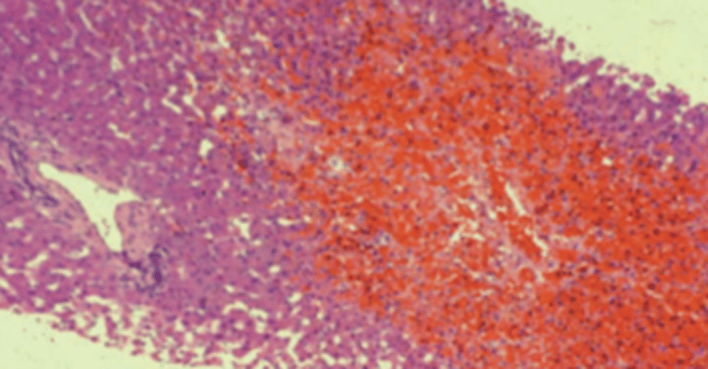 <p>A 28-year-old woman presents with a 4-day history of abdominal pain and increasing abdominal girth. She does not drink alcoholic beverages but smokes a pack of cigarettes a day. Except for oral contraceptives, she takes no medications. Physical examination shows hepatomegaly, ascites, and mild jaundice. A liver biopsy is obtained (shown in the image). Which of the following is the most likely diagnosis?</p><p>(A) Budd-Chiari syndrome</p><p>(B) Chronic hepatitis B</p><p>(C) Extrahepatic cholestasis</p><p>(D) Primary biliary cirrhosis</p><p>(E) Secondary biliary cirrhosis</p>