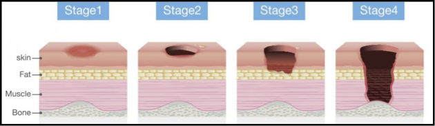 <p>outline pressure as a cause of localised atrophy </p>
