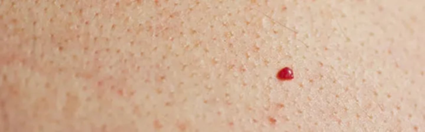<p>Common acquired vascular proliferation</p><p>Usually develop in the 4th decade and increase in number over time</p>