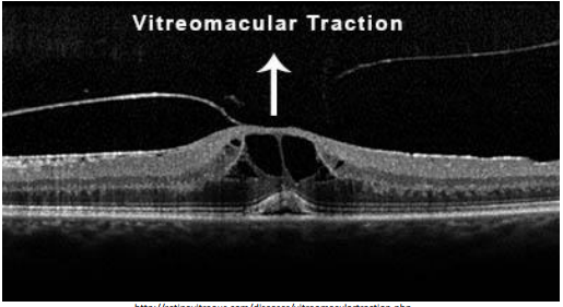 <p>The Vitreoretinal Interface </p><p>Vitreous cortex attached to ILM at : </p><ul><li><p><strong>Vitreous base </strong></p></li><li><p><strong>Optic disc </strong></p></li><li><p><strong>Macula </strong></p></li><li><p><strong>Vessels </strong></p></li></ul><p><strong>Strongest in youth </strong></p><p>Traction may occur with </p><ul><li><p>Liquefaction changes </p></li><li><p>Trauma</p></li></ul><p></p>