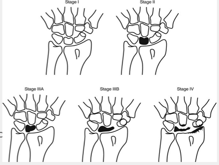 <ul><li><p>stage 1 = x-ray appears normal, osteonecrosis only seen on MRI or bone scane</p></li><li><p>2 = sclerosis of lunate</p></li><li><p>3a = lunate collapse (no carpal instability → radioscahpoid angle <60)</p></li><li><p>3b= lunate collapse (carpal instability → radioscahpoid angle >60)</p></li><li><p>4 = lunate collapse with degenerative arthritis</p></li></ul><p></p>