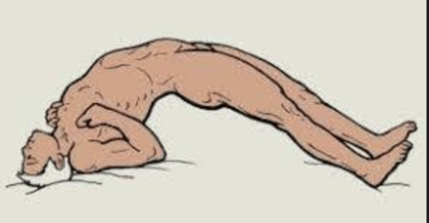 <p>The back is rigid and arching, and the head is thrown backward.</p><p>Spasm of tetanus</p>