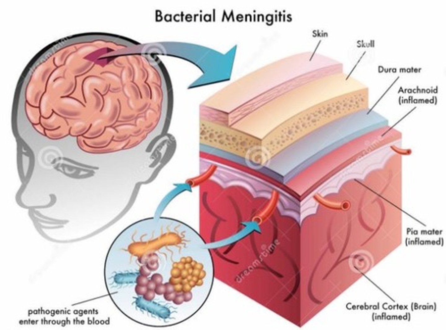 <p>Inflammation of meninges (layers covering the brain) caused by a bacterial or viral infection; life threatening; 20-25% fatal</p>
