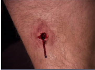 <p>VULNUS SCLOROPECTUM</p><ul><li><p><strong>penetrating wound</strong> caused by a <strong>projectile (bullet)</strong> from a firearm</p></li><li><p>Bullet size (caliber) determines damage done </p></li><li><p>Velocity and energy (high-velocity = more destructive)</p></li><li><p>Distance from shooter</p></li><li><p class="">Rotation/spin of bullet</p></li><li><p class="">Tissue type and elasticity:</p><ul><li><p class="">Elastic tissues (e.g., muscle, skin) stretch and may recover</p></li><li><p class="">Non-elastic tissues (e.g., brain, liver, spleen) are damaged severely</p></li></ul></li><li><p class="">May have <strong>small entry</strong> + <strong>larger exit wound</strong></p></li></ul><p class=""></p><p>Tissue Damage – 3 Zones:</p><ol><li><p>Zone of destruction </p><ul><li><p>necrotic canal </p></li><li><p>irreversible </p></li><li><p>foreign bodies </p></li></ul></li><li><p>Zone of contusion </p><ul><li><p>irregular bruised tissue </p></li><li><p>irreversible </p></li></ul></li><li><p>Zone of concussion</p><ul><li><p>outer area</p></li><li><p>vessel spasm </p></li></ul></li></ol><p></p><p>-Bullet fragments, shattered bones cause more wounding</p><p>Treatment:</p><ul><li><p>irrigate</p></li><li><p>debridement</p></li><li><p>exploration </p></li><li><p>bullet removal</p></li><li><p>dressing</p></li><li><p>antibiotics</p></li></ul><p></p>