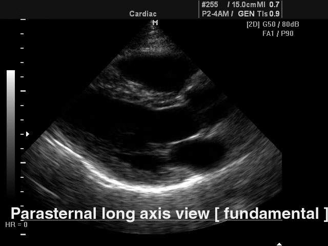 <p>PSLA VIEW</p><p>Parasternal long access view</p>