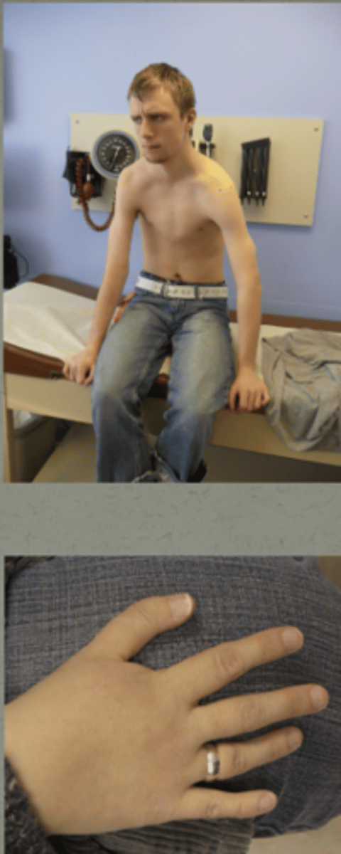 <p>Holt-Oram Syndrome</p><p>digitized</p><p>TBX5 mutation</p>