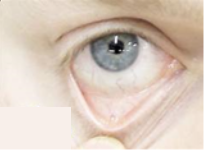 <p><span>How would you document the assessment findings of this patient’s conjunctiva?</span></p><p></p>