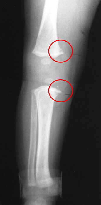 <p>The fractures demonstrated in this image of a 6 month old child are known as corner fractures. What is another name for them?</p>