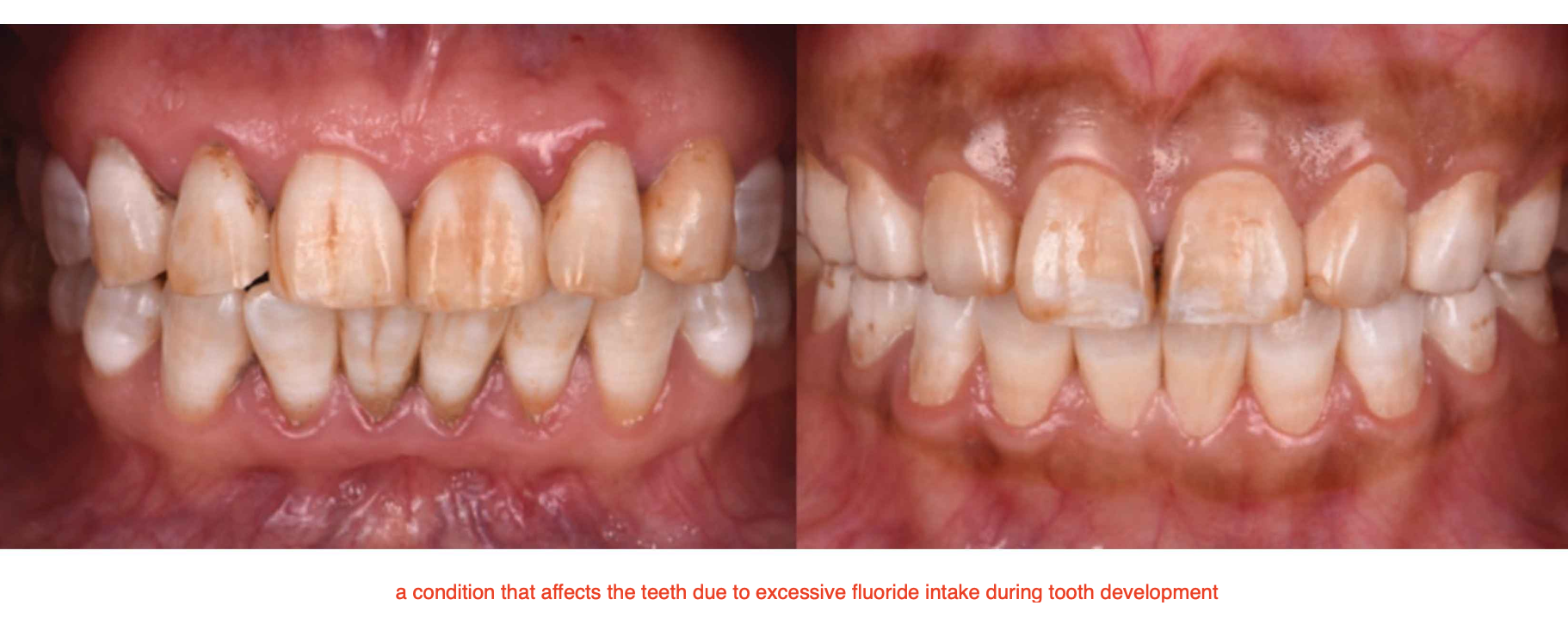 <p></p><ul><li><p>Areas of <strong>increased enamel porosity</strong> along the <strong>striae of Retzius </strong>(so<strong> </strong><span>excessive fluoride)</span></p></li><li><p><strong>Hypomineralized lesions</strong> that can extend throughout the enamel</p></li><li><p>Can lead to pits, bands, attrition, abrasion, and loss of extensive areas post-eruptively</p></li></ul><p></p>