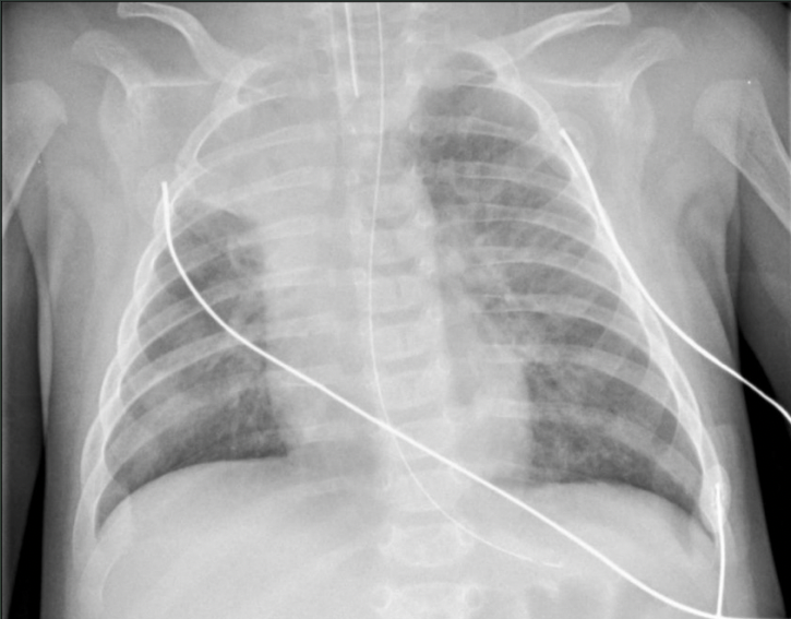 <p>What pathology is seen on this x-ray?</p>