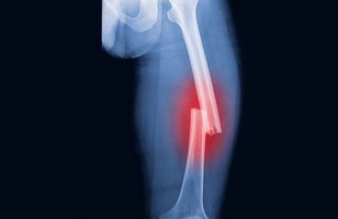 A crack or break in a bone.  