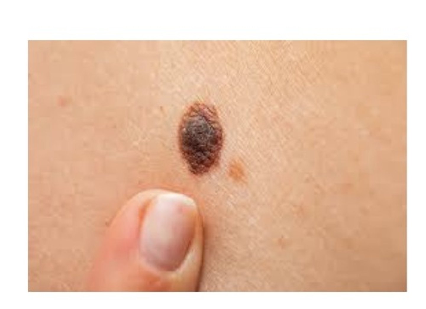 <p>———— may refer to either a developmental tumour of melanocytes or a pigmented congenital lesion, also known commonly as a "mole". Can arise on the skin or oral mucosa. Intraoral tumours consist of tan-to-brown macules or paperless. Occur most often on the hard palate or buccal mucosa. Occur twice as often in woman as men.</p>