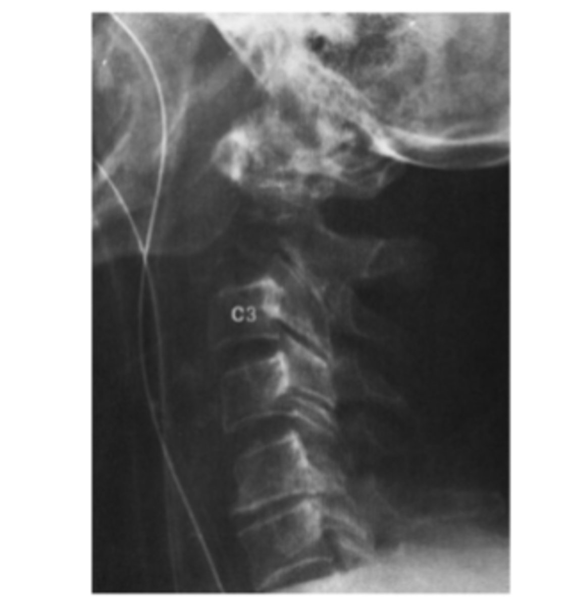 <p>On the lateral cervical spine radiograph. what is the main radiologic finding?</p><p>A lesion of the C7 spinous process</p><p>An osteoblastic bony lesion</p><p>An abnormality of alignment</p><p>A destructive lesion at C2</p><p>A fracture</p>
