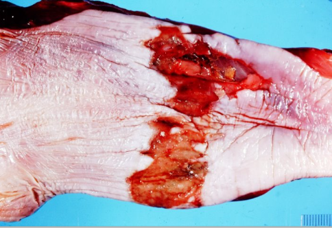 <p>What is this oesophageal disease and its nature</p>