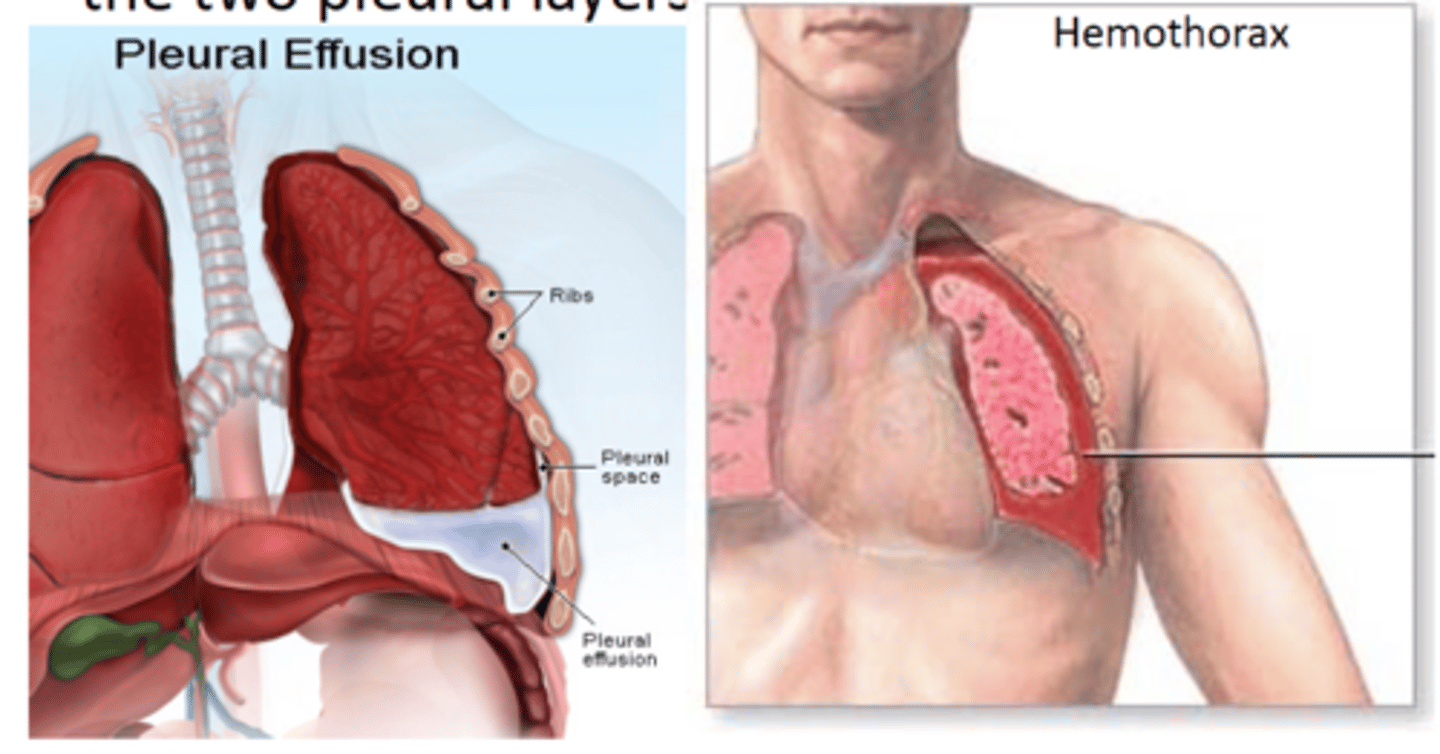 <p>blood in the pleural space</p>