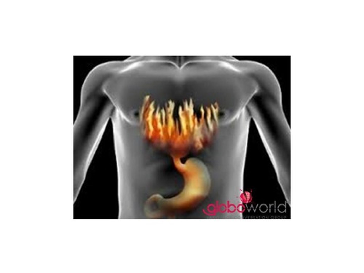 <p>heartburn (gyomorégés)</p>