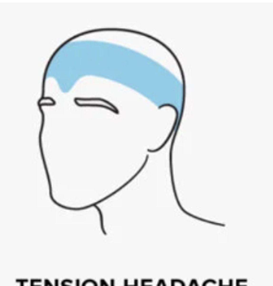 <p>- AKA stress headaches</p><p>- occur due to stress, anxiety, depression, emotional conflicts or other stimuli</p><p>- around the back of the head, the temples, and the forehead, almost as though a tight hat is squeezing the head</p><p>- onset: teenage years</p><p>- female &gt; male</p>