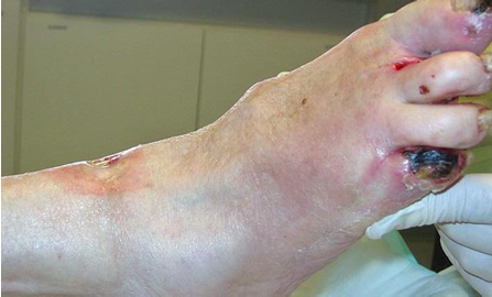 <p>Obtain urgent referral to vascular surgeon, be in communication with primary physician and document this. Consider ER if gangrene moist or worsening (i.e. toe turning purple)</p>