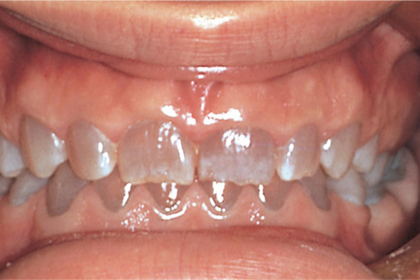 <p>- Abnormal dentin due to disturbances in odontoblasts during development<br>- Appearance: Translucent or opalescent, gray to bluish-brown</p>
