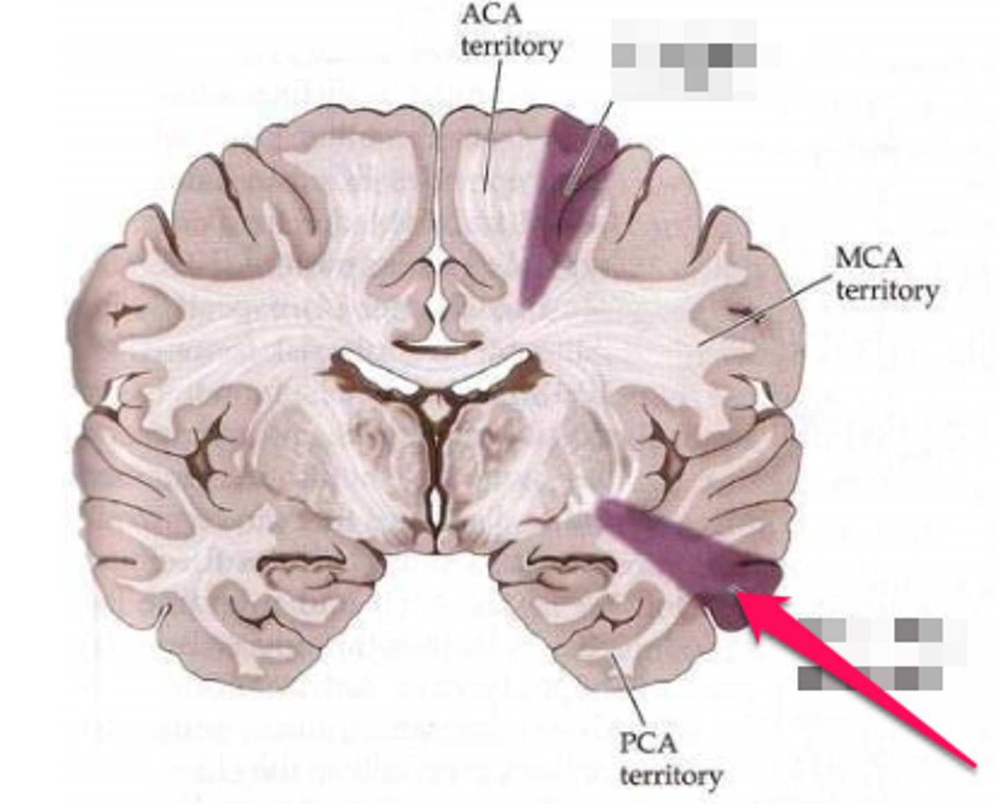 <p>Watershed infarcts in MCA-PCA watershed zone region cause these symptoms:</p>