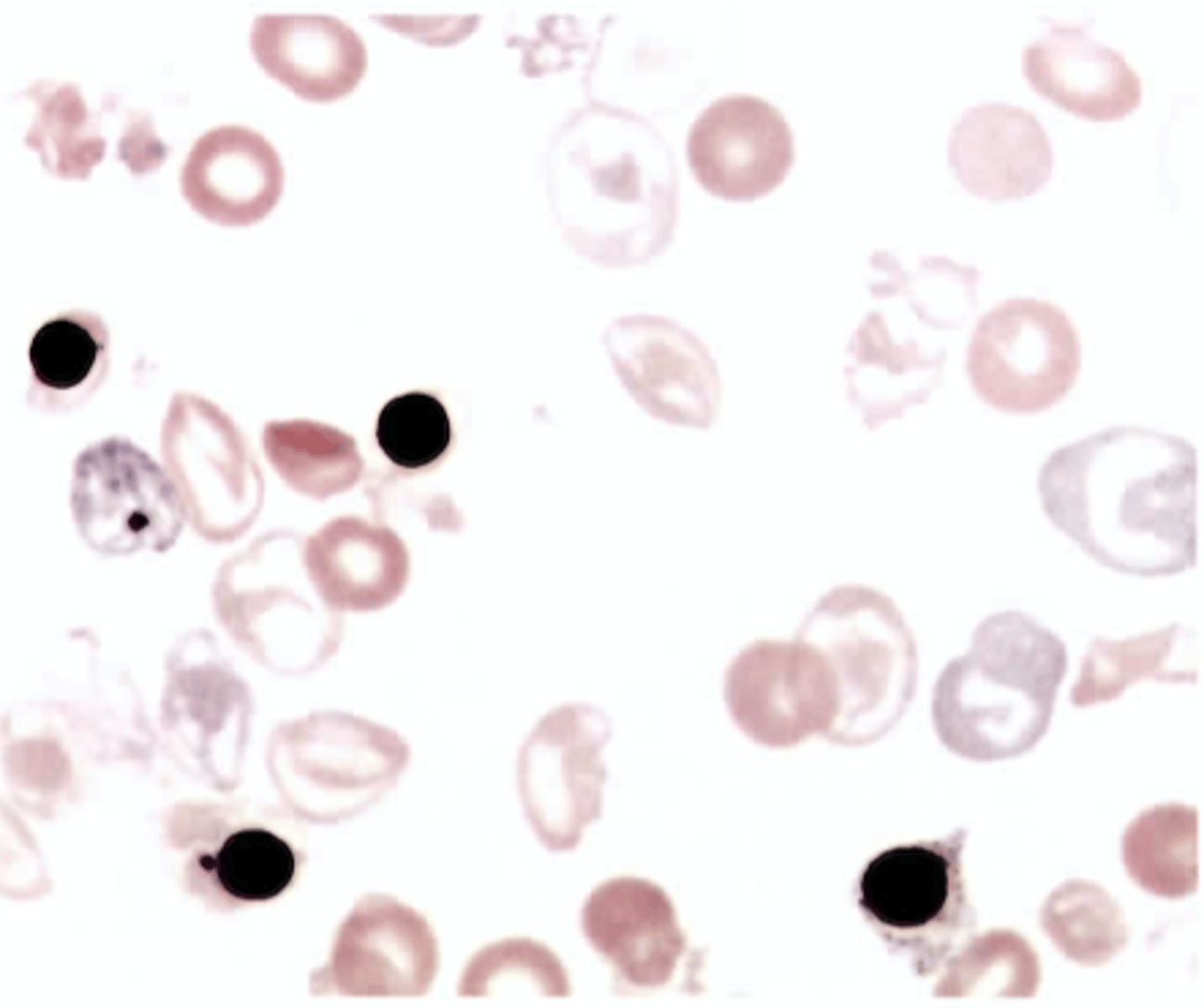 <p>B. Cooley beta-thalassemia major</p>