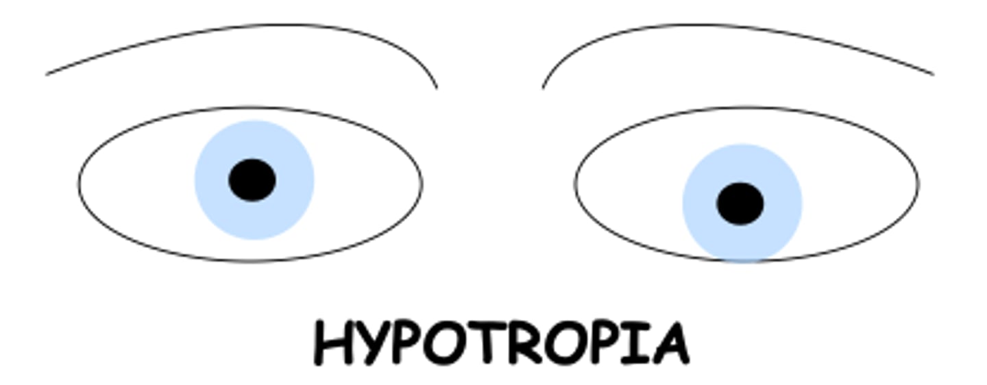 <p>one eye deviates downward relative to the other</p>