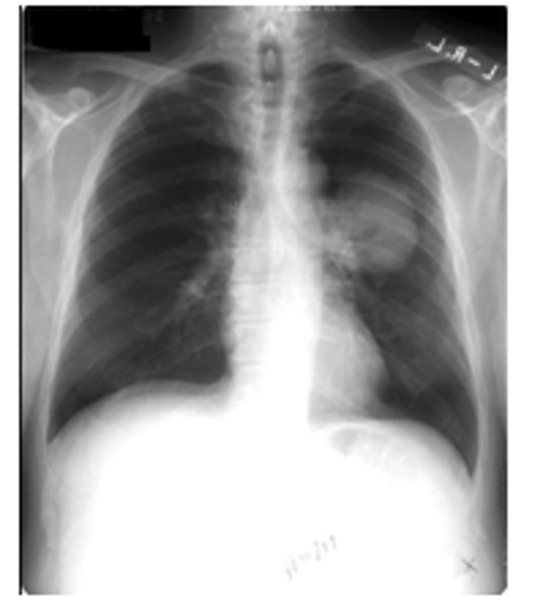 <p>can occur peripherally or centrally and grow rapidly with early metastases - poor prognosis.</p>