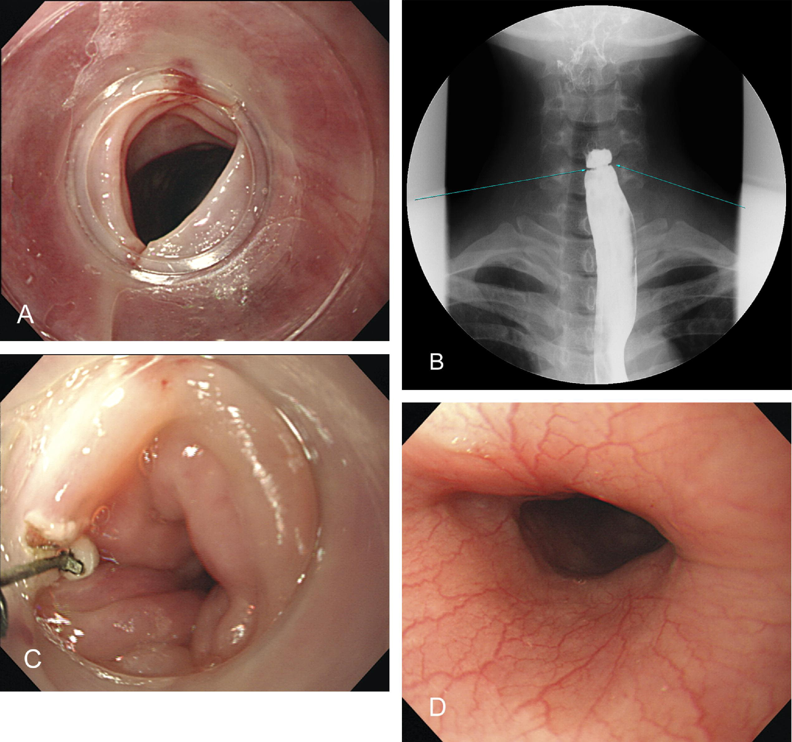 <p>fyi: Iron-deficiency anemia characterized by esophageal webs, atrophic glottis and spoon-shaped brittle fingernails&nbsp;</p>