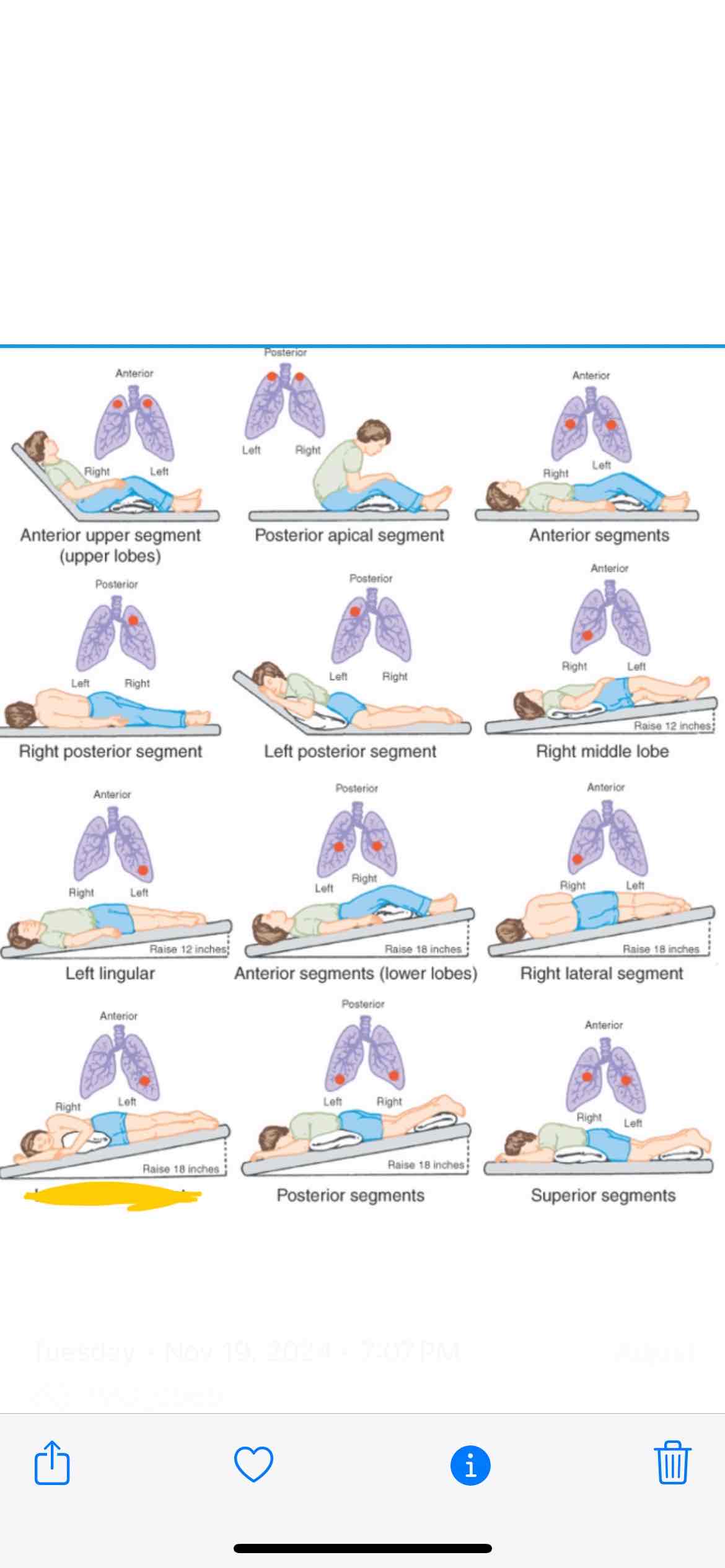 <p><span>Which lung segment does this position effect</span></p>