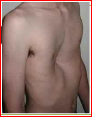 <p>Câu 59: Pectus <span style="color: red;">excava</span>tum là <span style="color: blue;">tên gọ</span>i của<span style="color: yellow;"> dị tật lồng ngực</span> nào?<span>&nbsp;</span></p><p class="MsoNormal">A. Lồng ngực <span style="color: red;">hình phễu</span><span style="font-family: "Segoe UI Symbol", sans-serif;"><span>✓</span></span><span>&nbsp;</span></p><p class="MsoNormal">B. Lồng ngực hình ức chim<span>&nbsp;</span></p><p class="MsoNormal">C. Lồng ngực phẳng<span>&nbsp;</span></p><p class="MsoNormal">D. Lồng ngực lệch<span>&nbsp;</span></p>