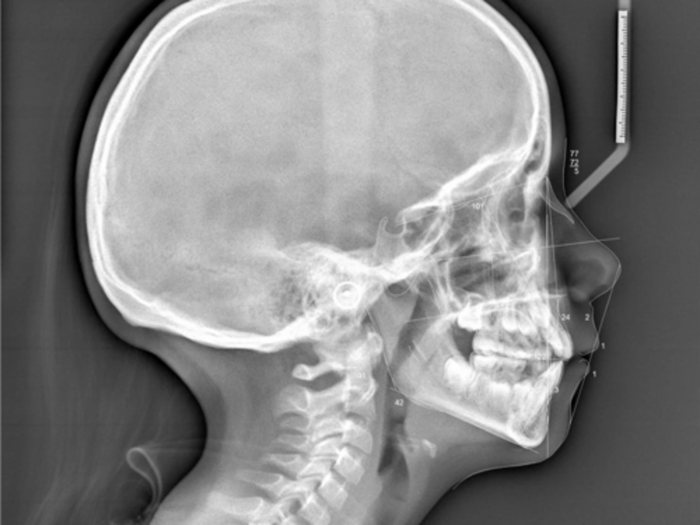 <p>What type of skeletal malocclusion is this patient?</p>