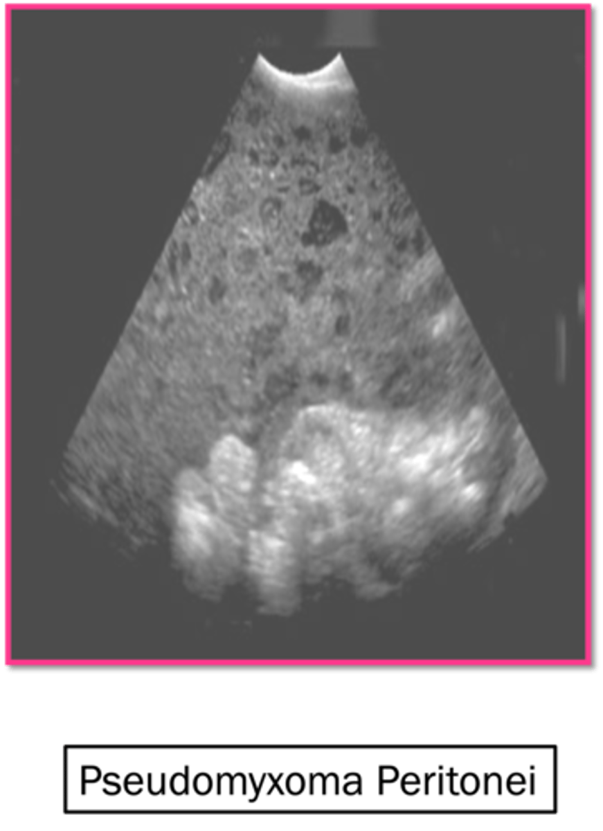 <p>pseudomyxoma peritoneum (collection of mucinous material in peritoneal cavity)</p>