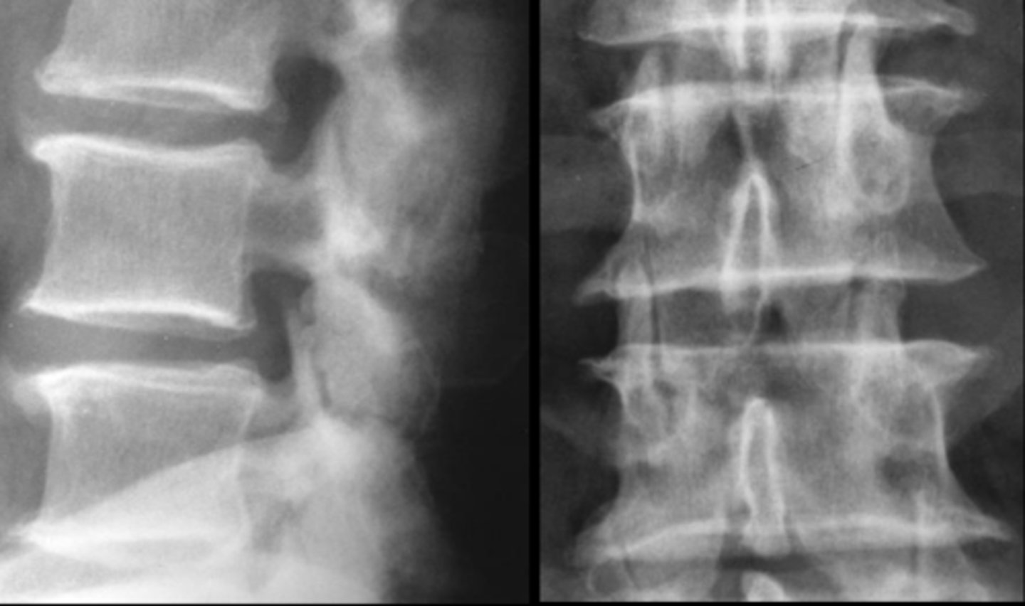 <p>ID type of degenerative spine disease in the lumbar spine</p>