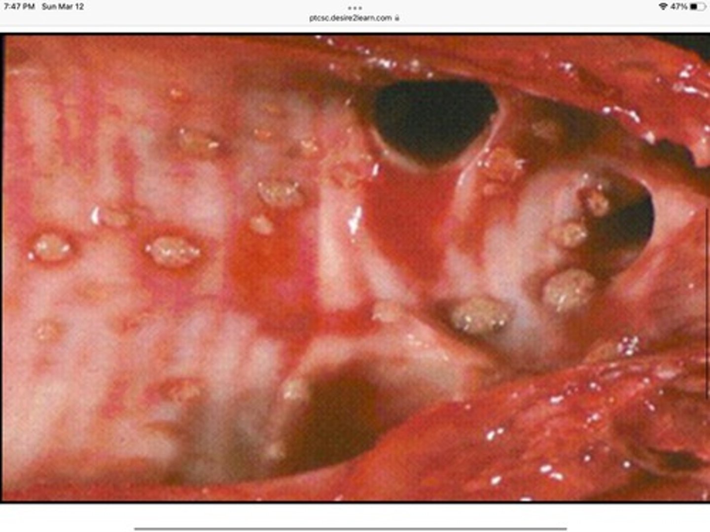 <p>Oslerus osleri</p>