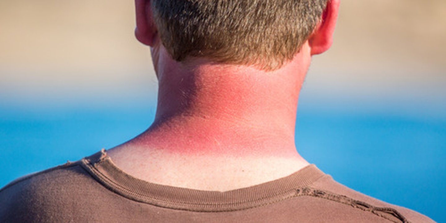 <p>redness of the skin caused by exposure to the rays of the sun</p>