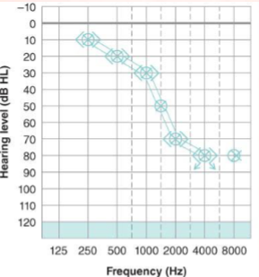 <p>What is a high-frequency sensorineural hearing loss?</p>